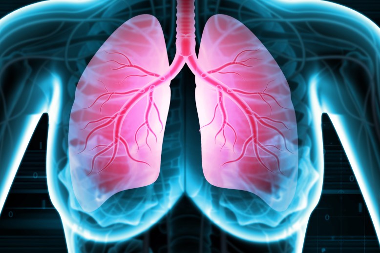 Pulmonary hypertension